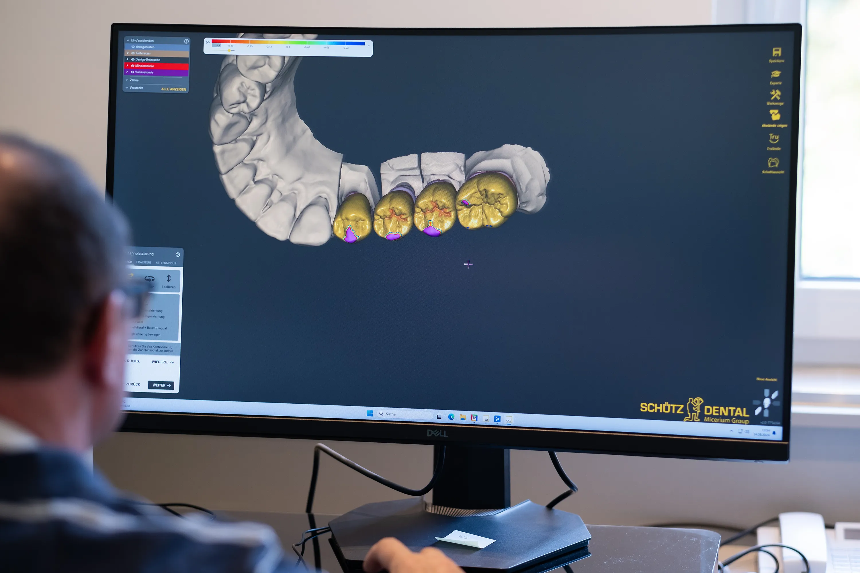 Digitales Krone-Design in ExoCAD — Konstruktion im Eigenlabor