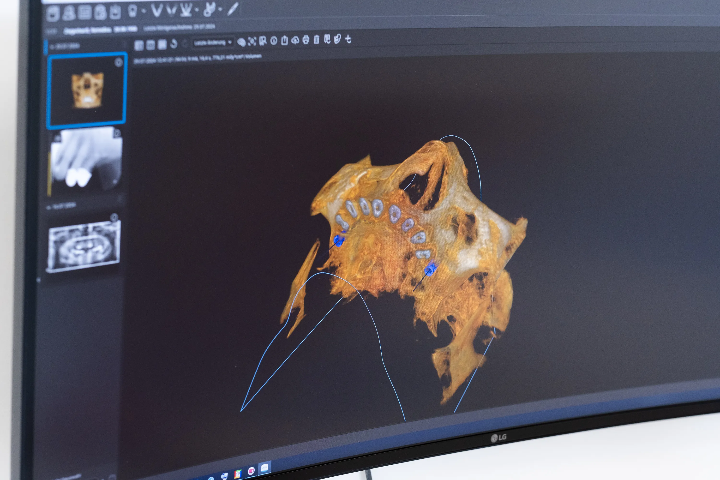 3D-Implantatplanung am Bildschirm
